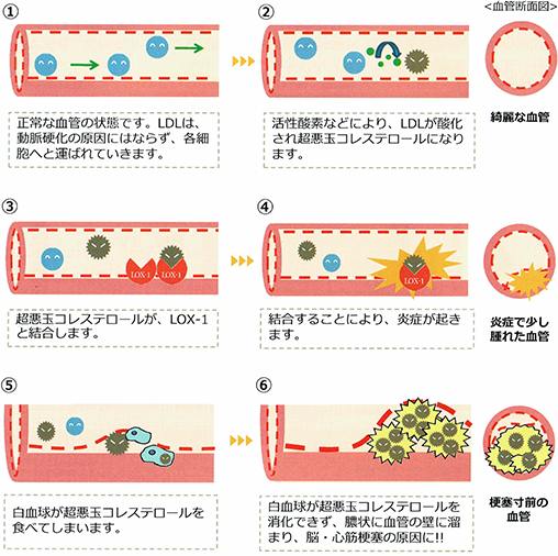 動脈硬化の原因を知ろう
